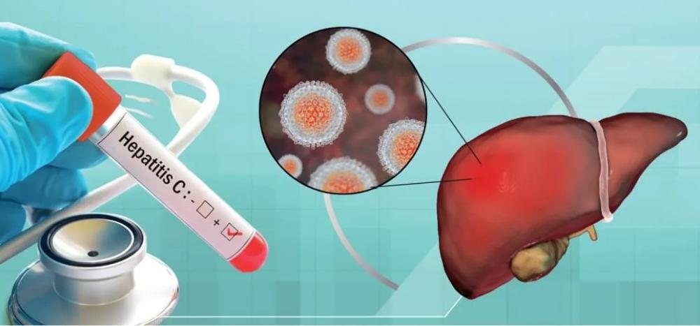 Что надо знать о гепатите С